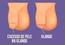 Imagem de um pênis circuncidado destacando informações sobre saúde sexual masculina